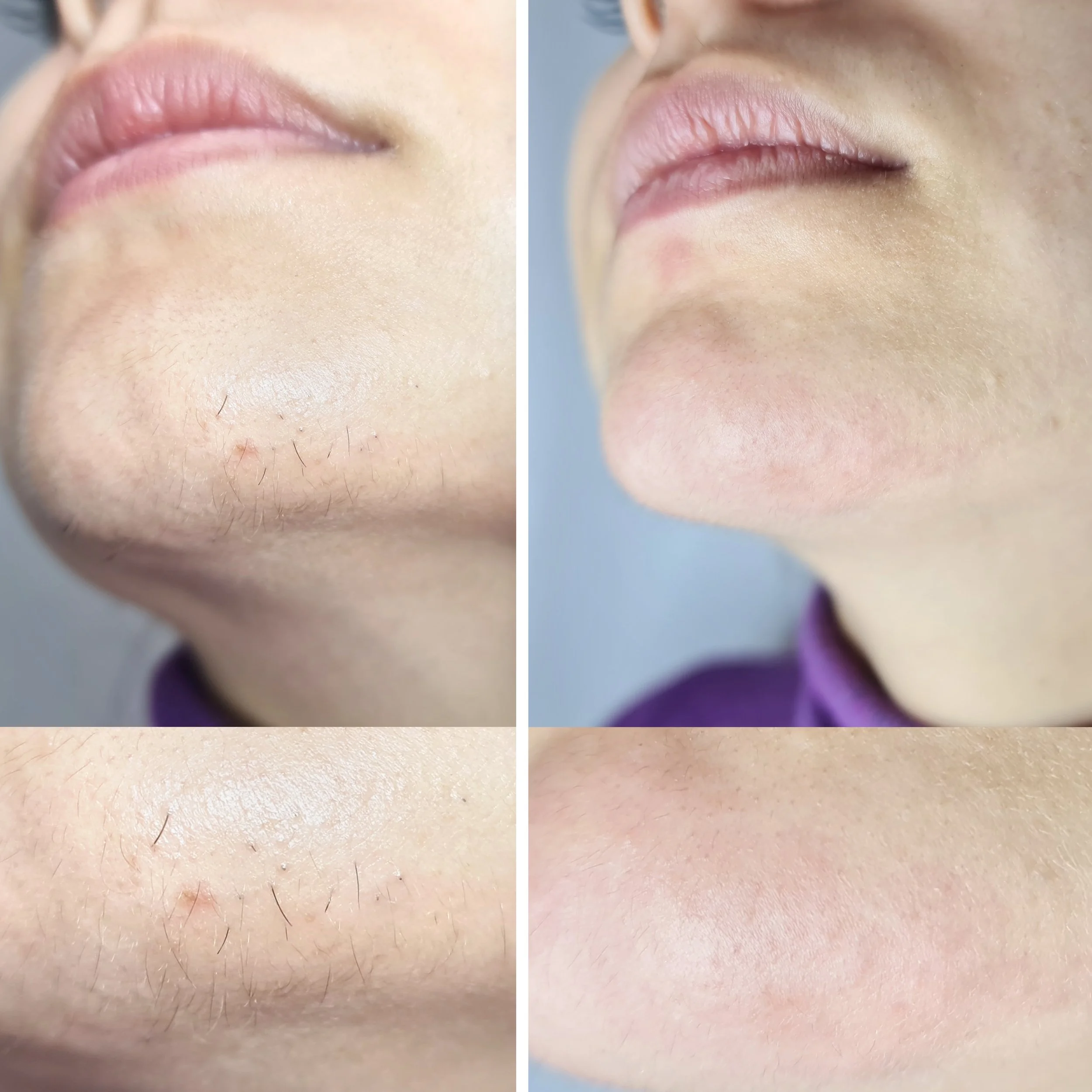 Before and after chin hair removal treatment