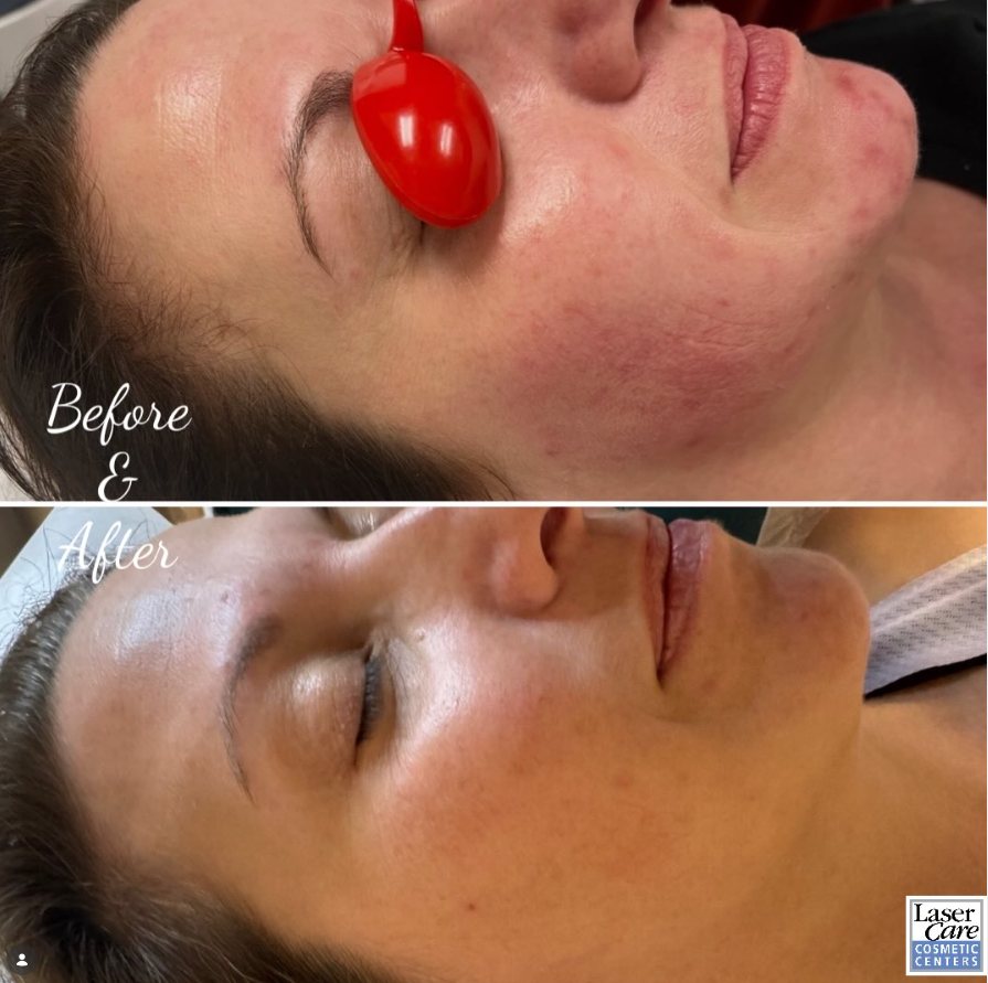 Before and after hydrofacial treatment showing calmer, smoother skin
