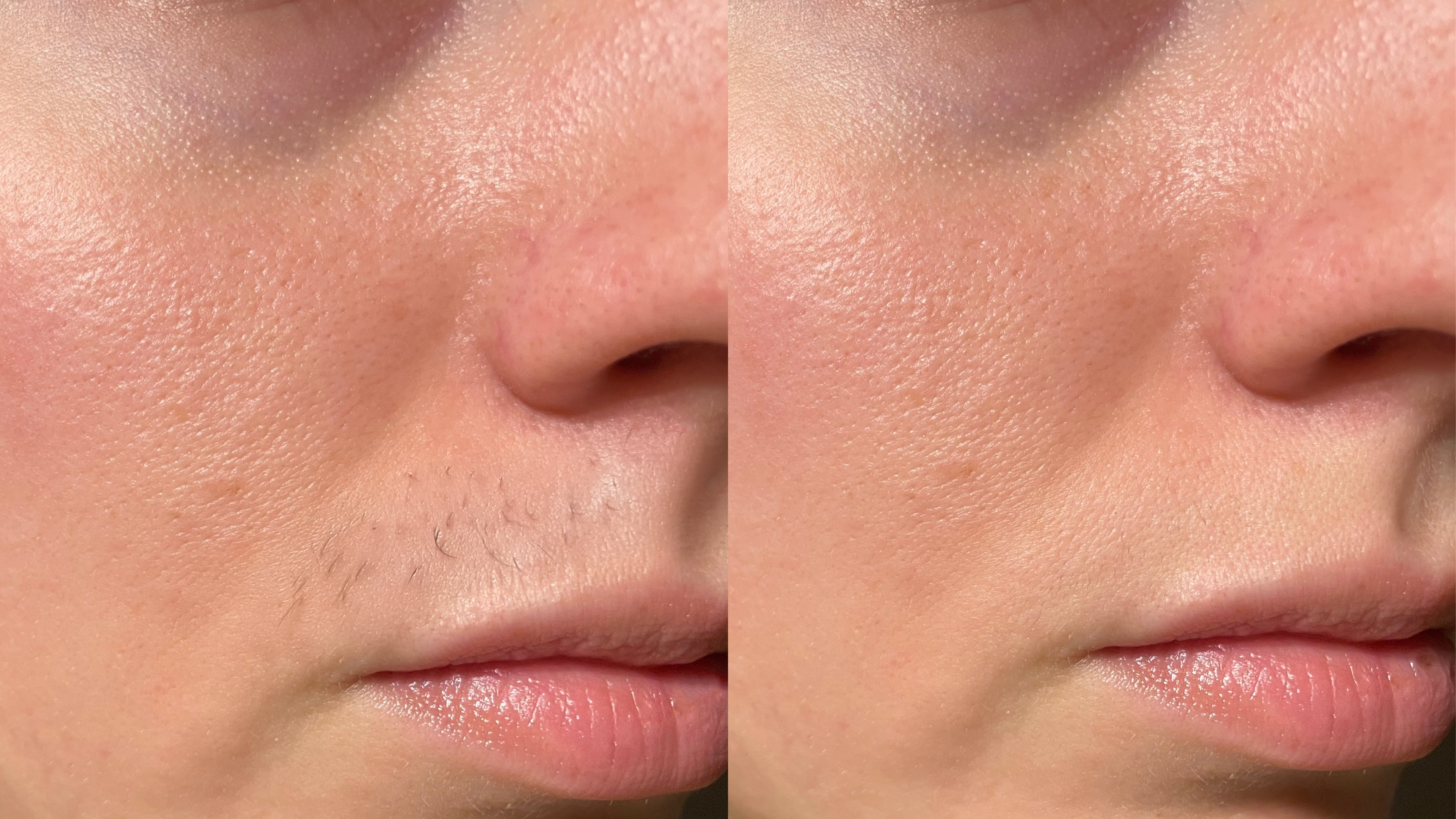 Before and after upper lip hair removal treatment